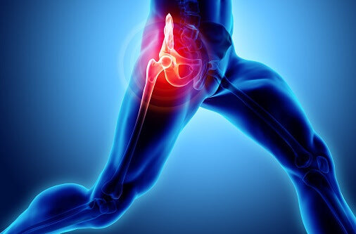 Chronic Piriformis Syndrome