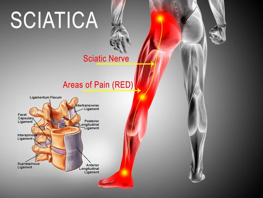 Chronic Sciatica Pain